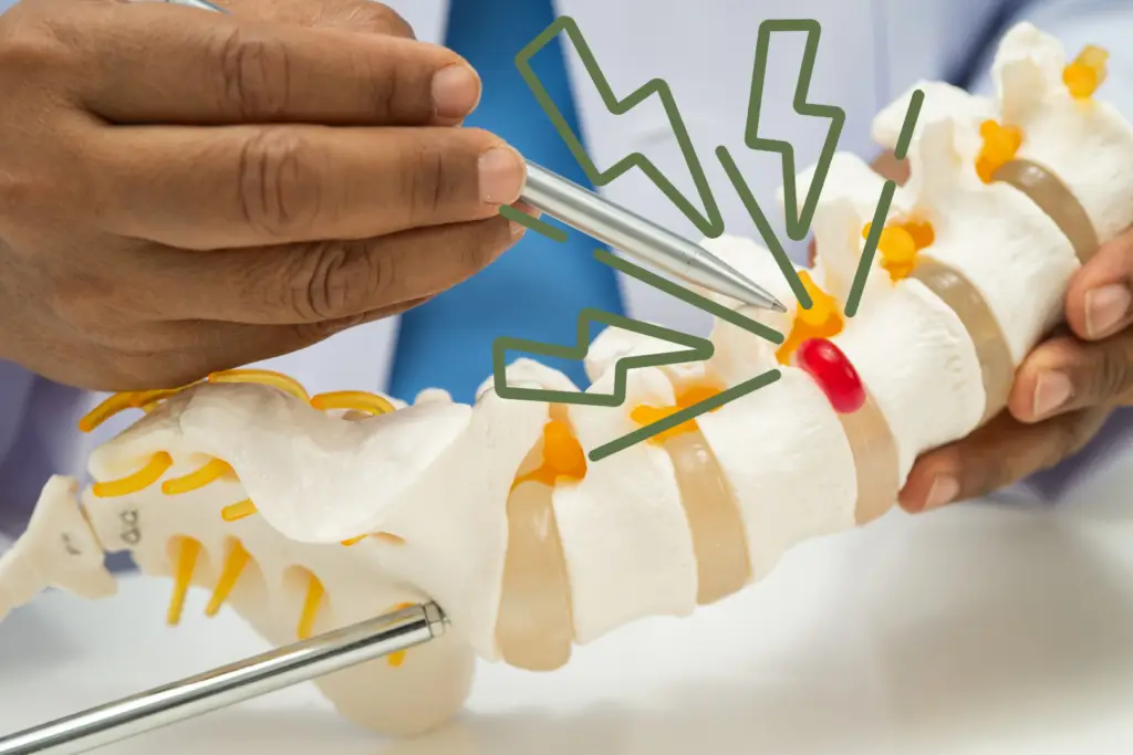 A doctor treating disc herniation with physiotherapy on a model spine